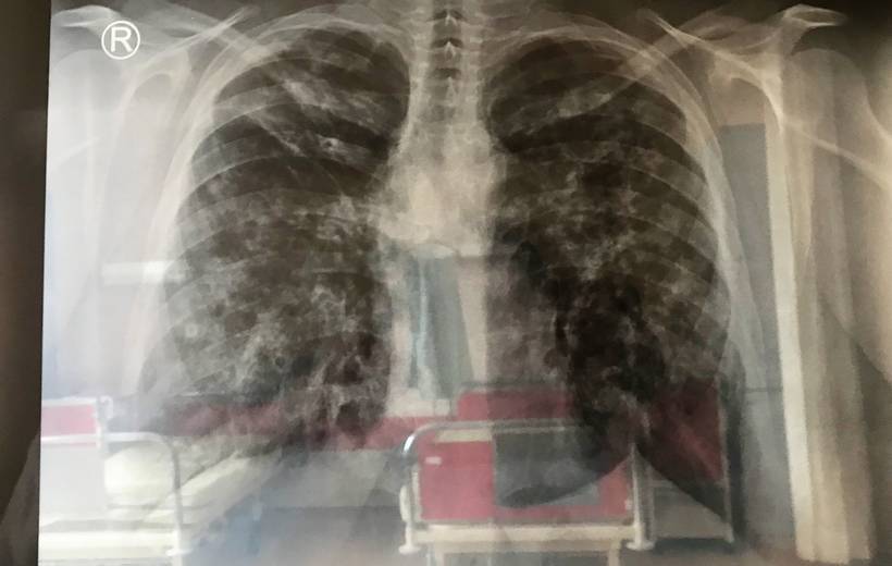 Μεταμόσχευση πνευμόνων - Αυστρία 